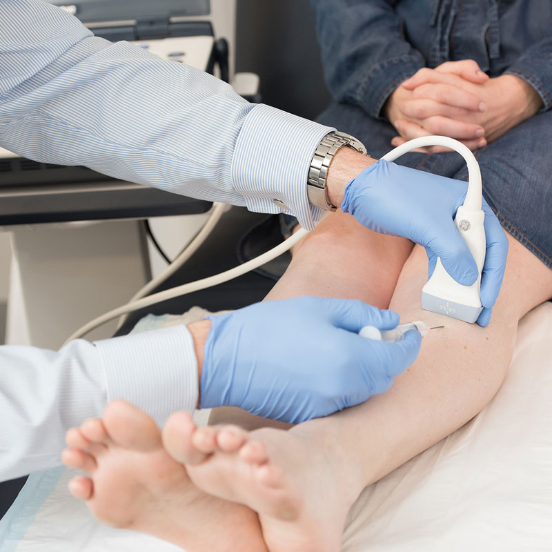 Traitements alternatifs des varices